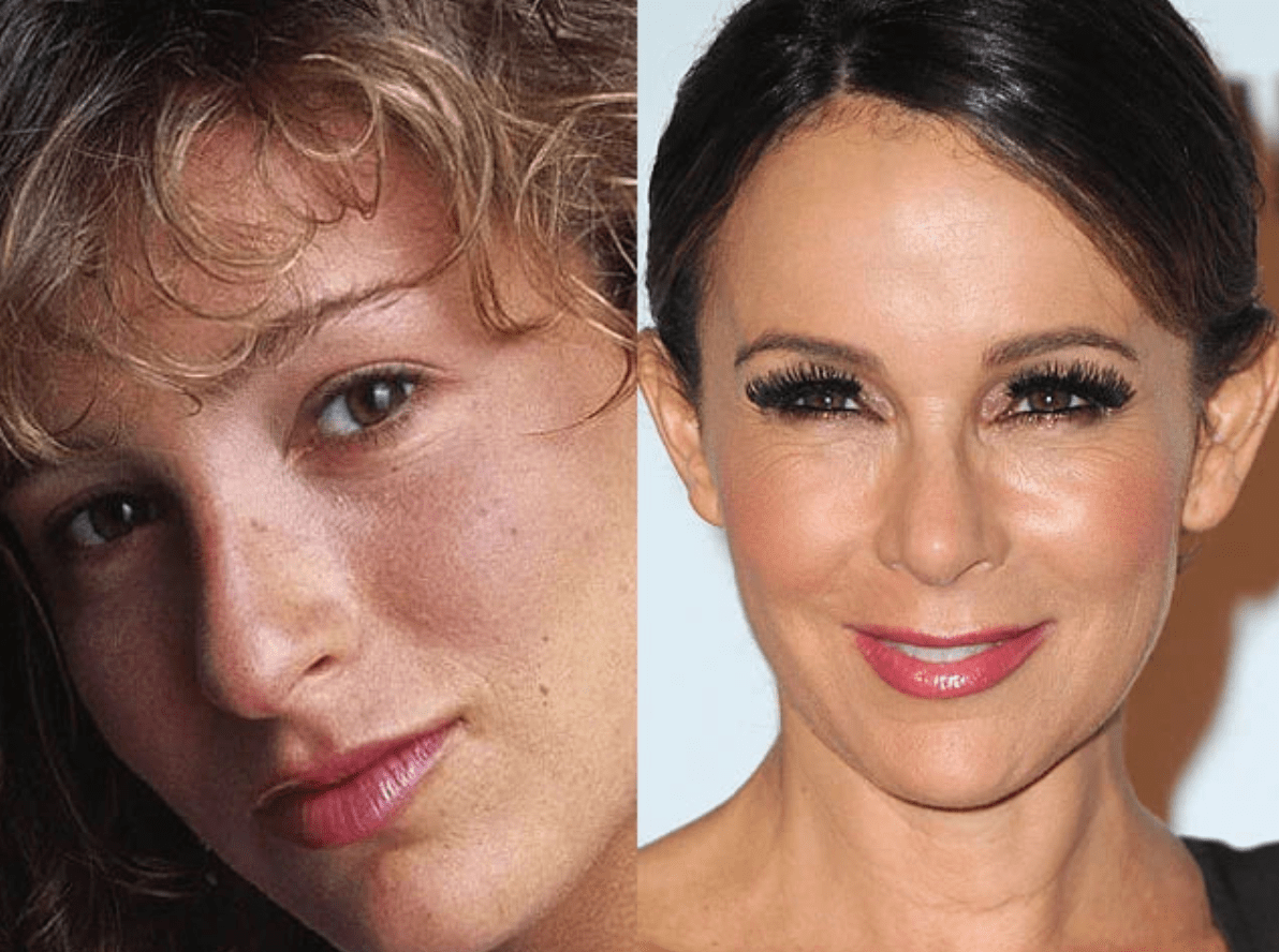 Celebridades cuyas cirugías plásticas causaron sensación: Lo que dicen los expertos ➤ Globenow.info