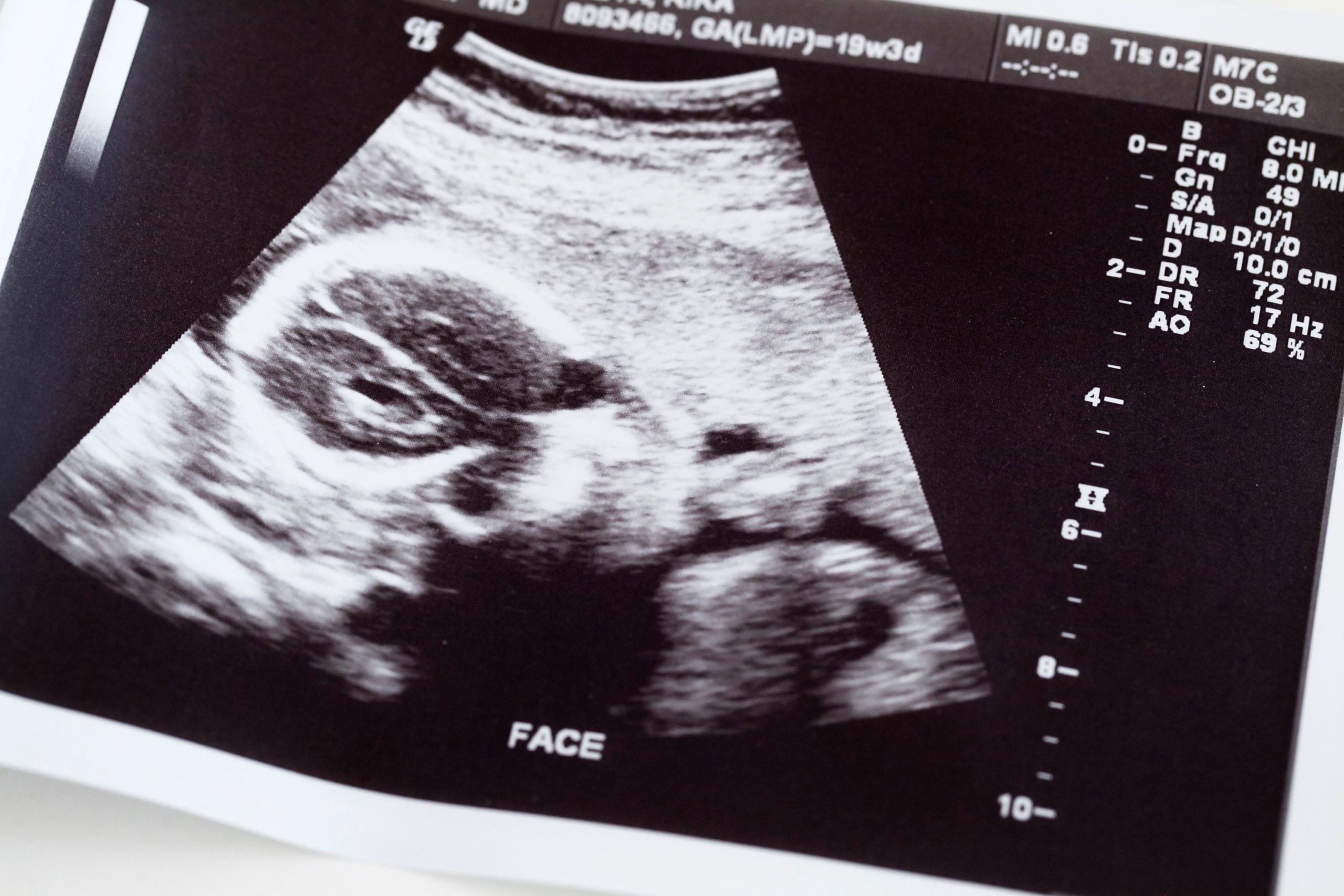 Ela pensava que sua gravidez havia terminado. Mas três semanas depois, os médicos descobriram algo inimaginável