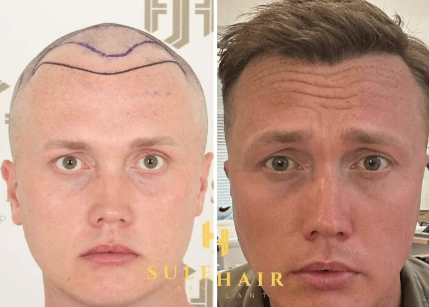 Como um transplante capilar muda a aparência: transformações e opiniões de especialistas