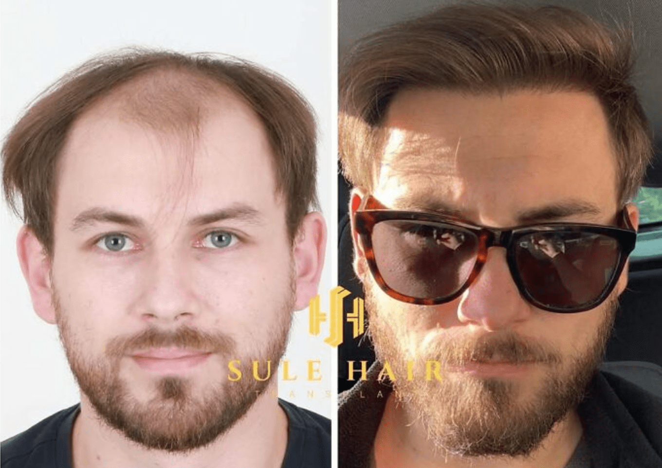 Como um transplante capilar muda a aparência: transformações e opiniões de especialistas